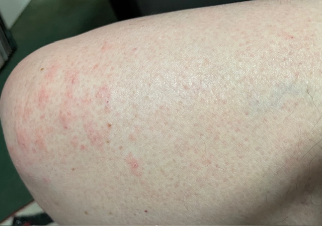 Poison Ivy Rash